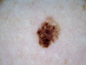 Superficial spreading melanoma, Breslow 0.5 mm, polarised dermoscopy view