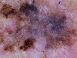 Superficial spreading melanoma, Breslow 0.6 mm, polarised dermoscopy view