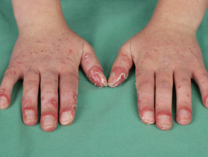 Systemic lupus erythematosus of the fingers