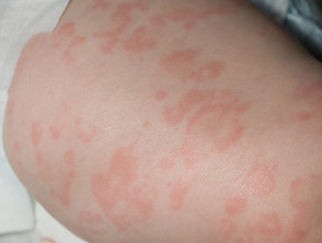 Cryopyrin-associated periodic syndrome rash