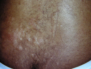 Shagreen patch in tuberous sclerosis