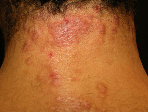 Skin lesions in Whipple disease