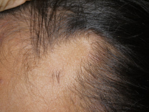 Triangular temporal alopecia