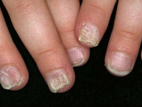 Twenty nail dystrophy