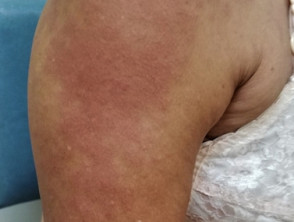 Urticaria affecting  the arm 