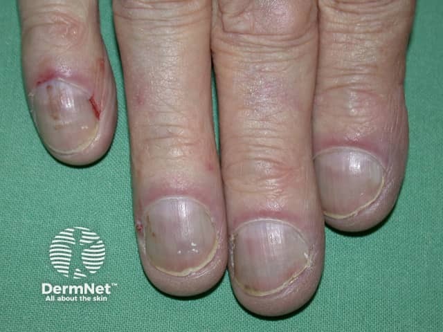 Cyanosis and clubbing