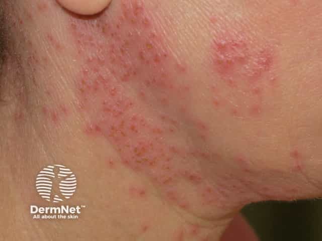 Eczema herpeticum