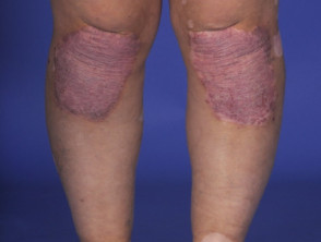 Vitiligo and psoriasis in patient with Vogt-Koyanagi-Harada syndrome