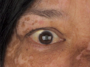 Vitiligo in Vogt-Koyanagi-Harada syndrome