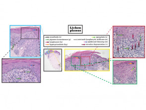 Histopathology of lichen planus