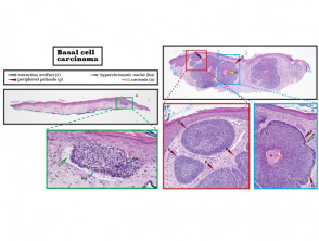 Histopathology of basal cell carcinoma