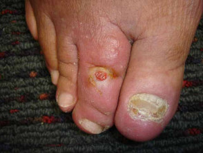 diabetic foot ulcer 00001