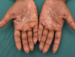 hand dermatitis 00032