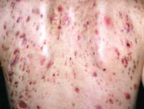 nodulocystic acne 00011