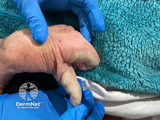 Hyperkeratotic plaques on the thumb and palms