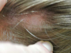Patchy alopecia areata in a child