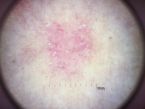 Dermoscopy of atopic dermatitis in adult with skin of colour