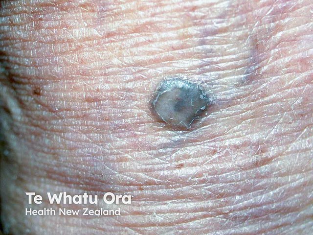 A blue naevus on the hand