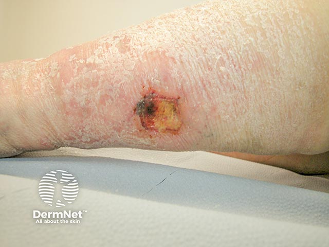 Retiform purpura due to vessel wall damage