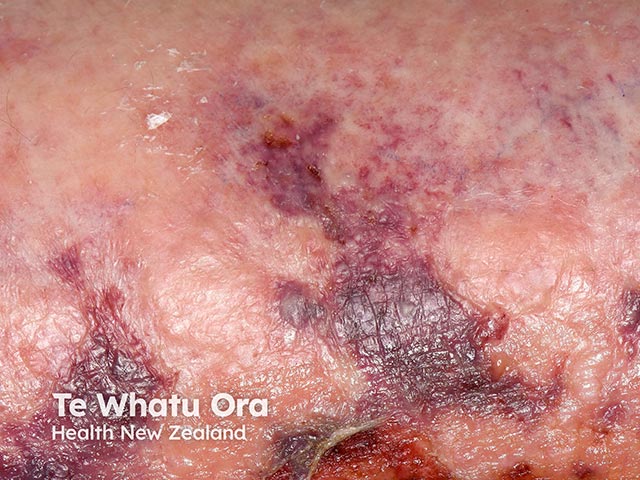 Retiform purpura with central jagged ulceration due to normorenal calciphylaxis