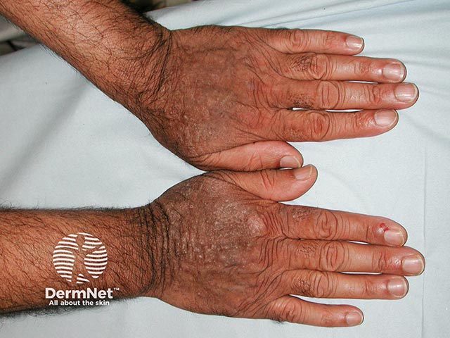 Dermatitis on the hands with a cut off at the wrists in CAD