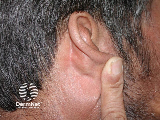Sparing of light-shielded skin under the ear lobe