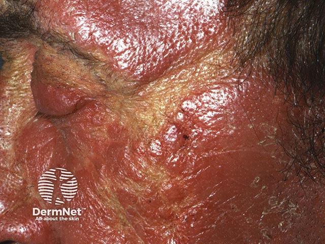Severe CAD with sparing in a light-shielded skin crease
