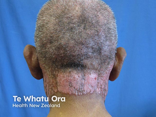 Chronic photosensitivity dermatitis