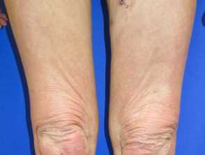 Chronic superficial scaly dermatitis