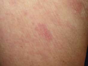 Chronic superficial scaly dermatitis