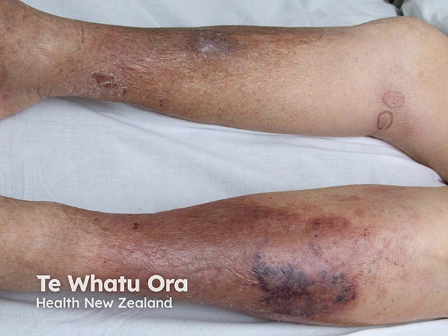 A haemorrhagic cellulitis-like eruption due to cryptococcosis