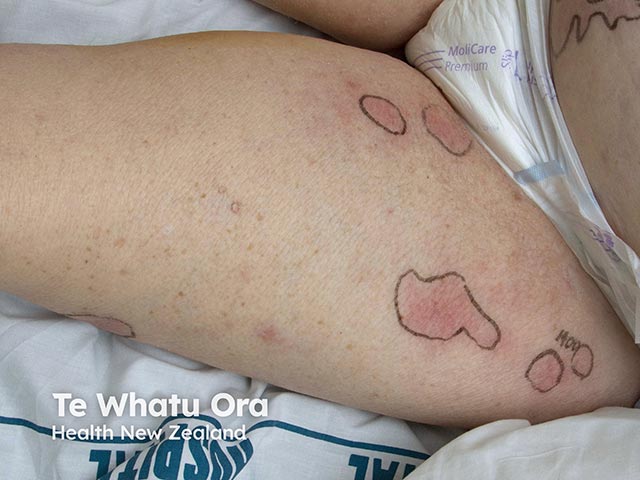 Spreading erythema due to disseminated cryptococcosis