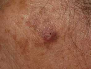 Cutaneous squamous cell carcinoma
