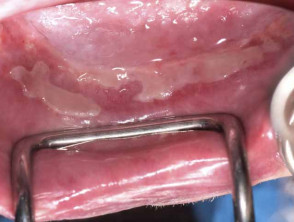 Traumatic mouth ulcers