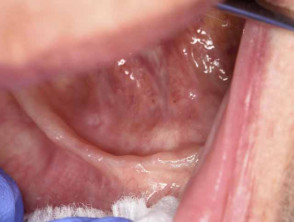 Traumatic mouth ulcers