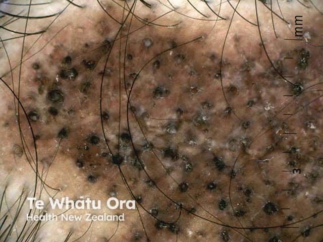 erythematosus  Discoid lupus erythematosus Scarring alopecia with follicular plugging in discoid lupus erythematosus