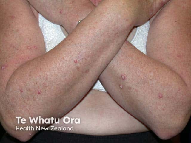 Warty papules on the arms in generalised eruptive keratoacanthomas