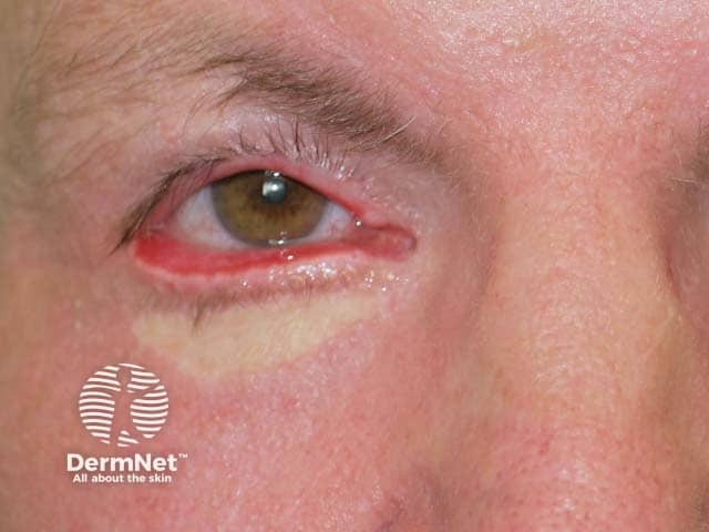 Ectropion with generalised eruptive keratoacanthomas