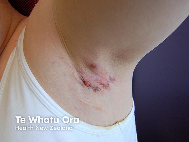 Folliculitis in Down syndrome