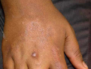leprosy borderline tuberculoid 00001