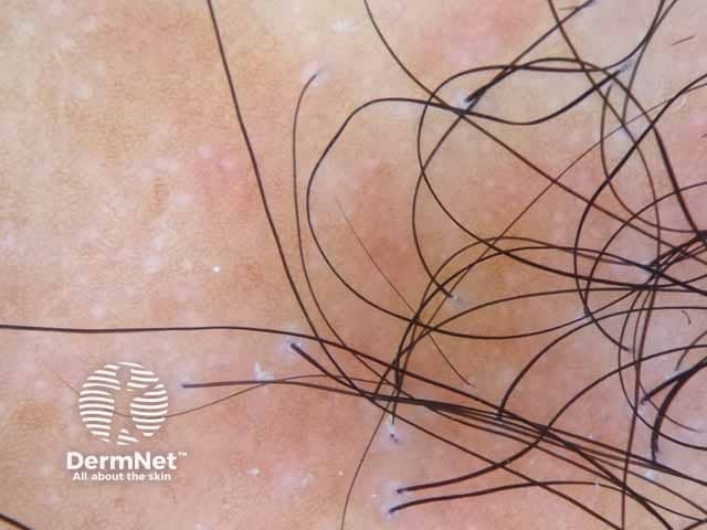 Dermoscopic image of Graham-Little syndrome showing perifollicular scales of the scalp lesion denoting lichen planopilaris