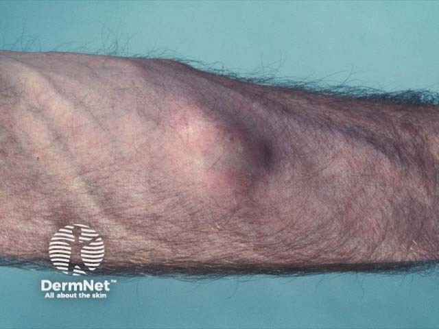 A lipoma in Dercum disease - it was one of several, and all were very painful