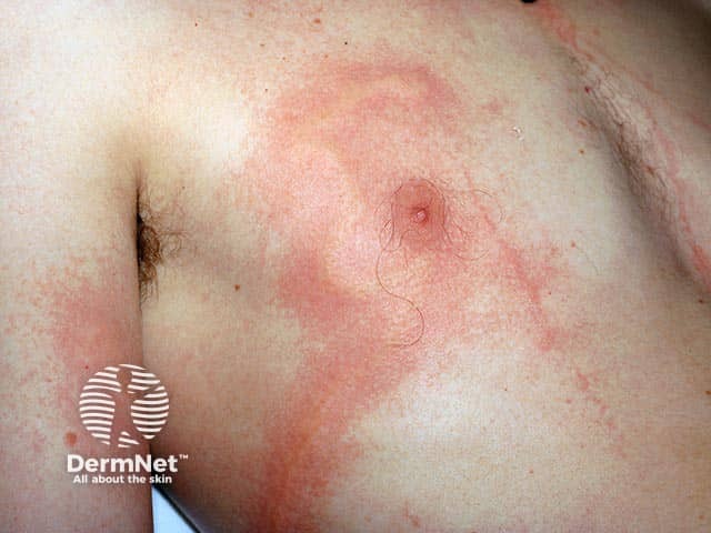 Urticated erythema in box jellyfish stings