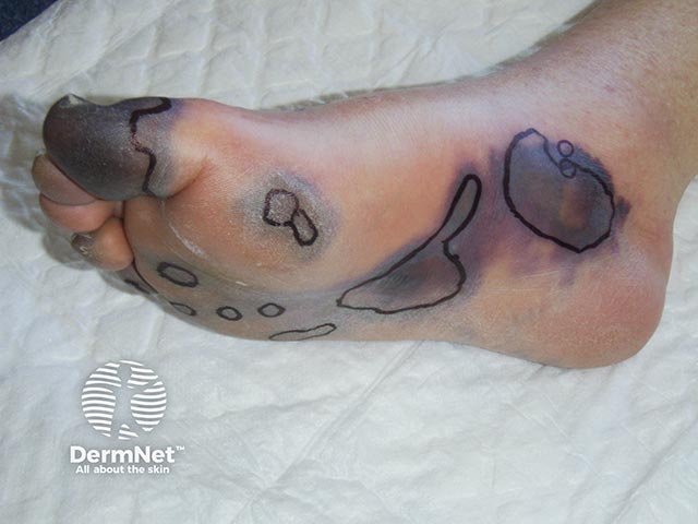 Haemorrhagic necrosis of the skin due to purpura fulminans - the marker lines have been added to assess extension