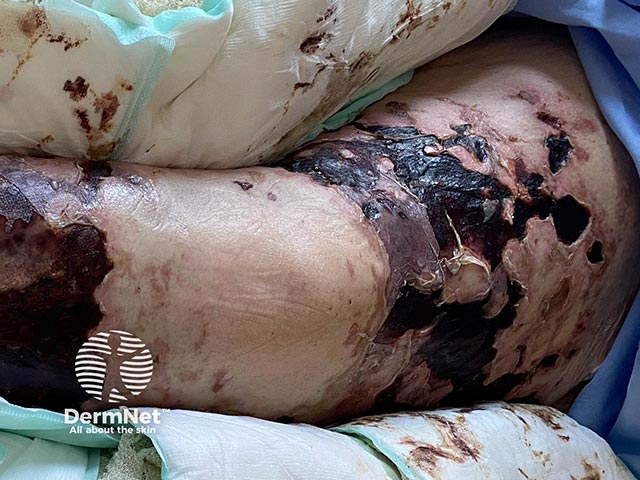 Skin necrosis resulting from purpura fulminans