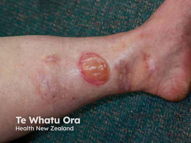 Bullous pyoderma gangrenosum with scars from previous ulcers on the lower leg
