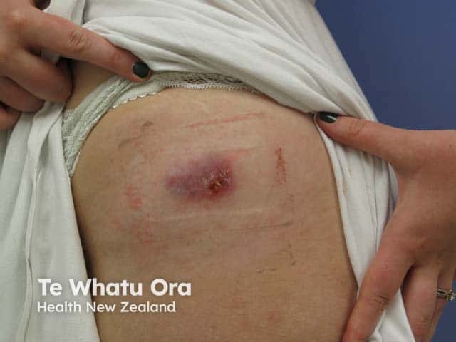 Pyoderma gangrenosum over the deltoid area