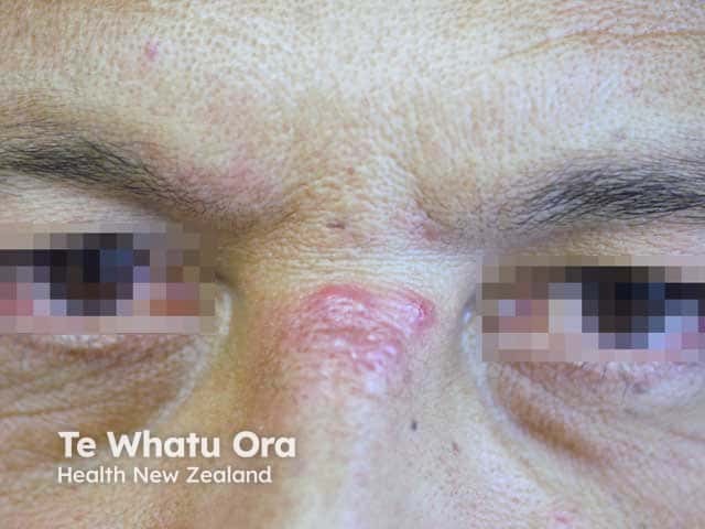 Granulomatous rosacea and rosacea eye disease