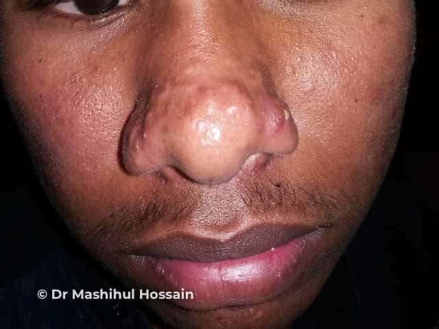Rhinophyma