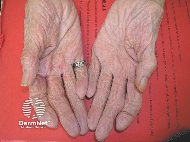 Early crusted scabies on the palms in an elderly care home resident